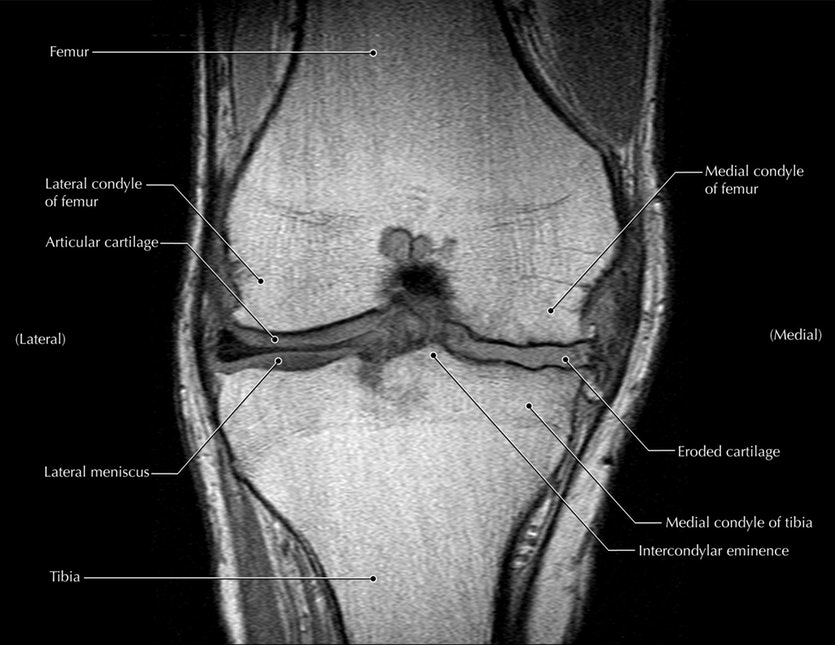 Mri of a knee with osteoarthritis