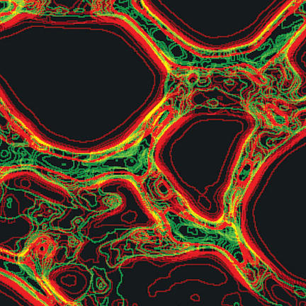 (Microscopy mesh-like image) A microscopy image of the hydrogel glue in green used to implant the nanoparticles (red) near a tumour.