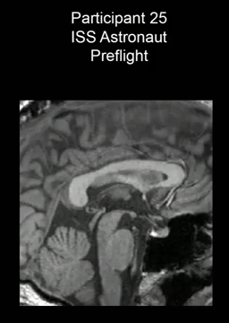 This postflight MRI cine clip shows evidence of an upward shift of the brain and narrowing of cerebrospinal spaces at the top of the brain of a NASA astronaut stationed aboard the International Space Station.