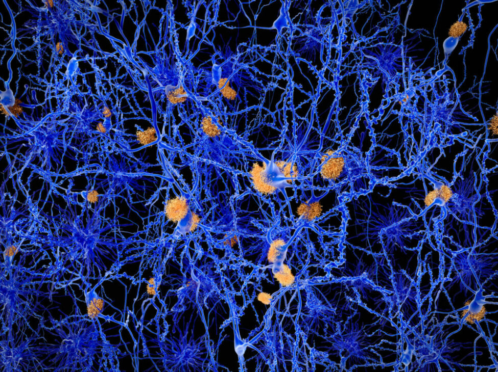 Amyloid plaques can be seen gumming up the spaces between neurons in this illustration.