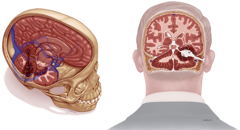 An illustration mapping the extent of the damage to senator kennedy's brain.
