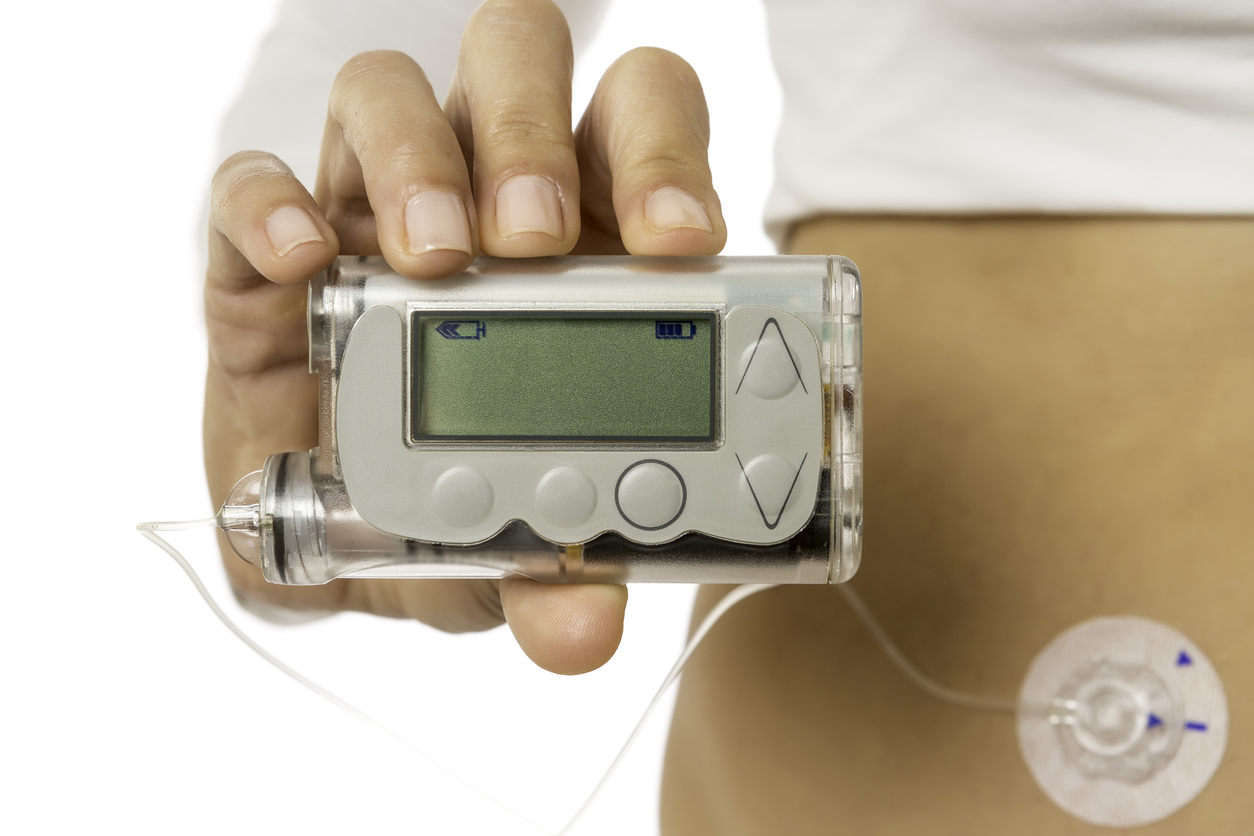 An artificial pancreas may be a new way forward for patients with type 1 diabetes.