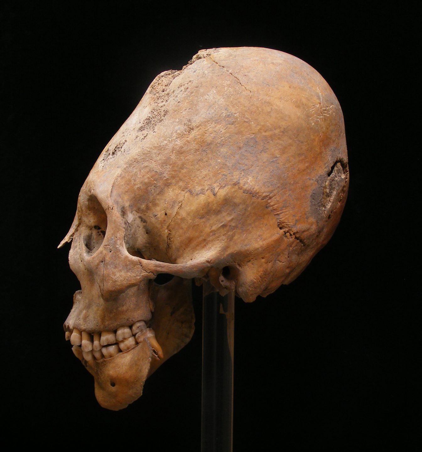 showing the modified elongated cranium the Huns achieved through binding the heads of their babies.