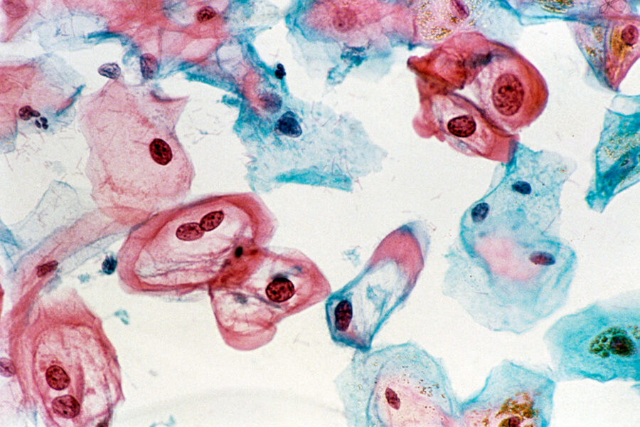 A light micrograph of cervical cells showing some abnormalities.