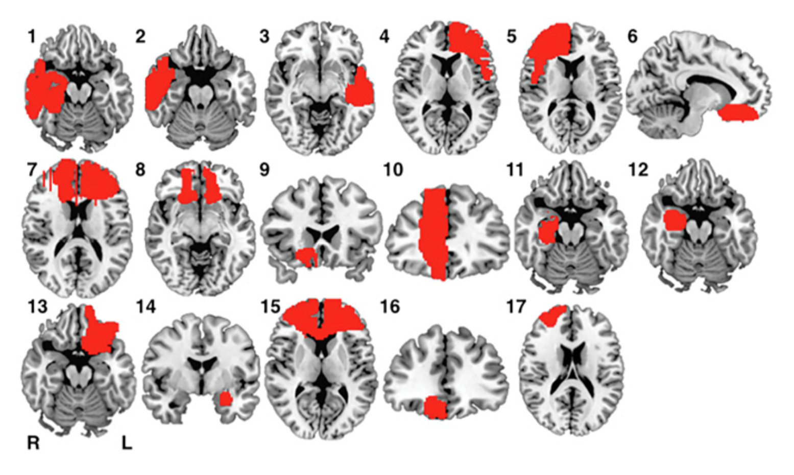 brain-lesions-contribute-to-criminal-behaviour