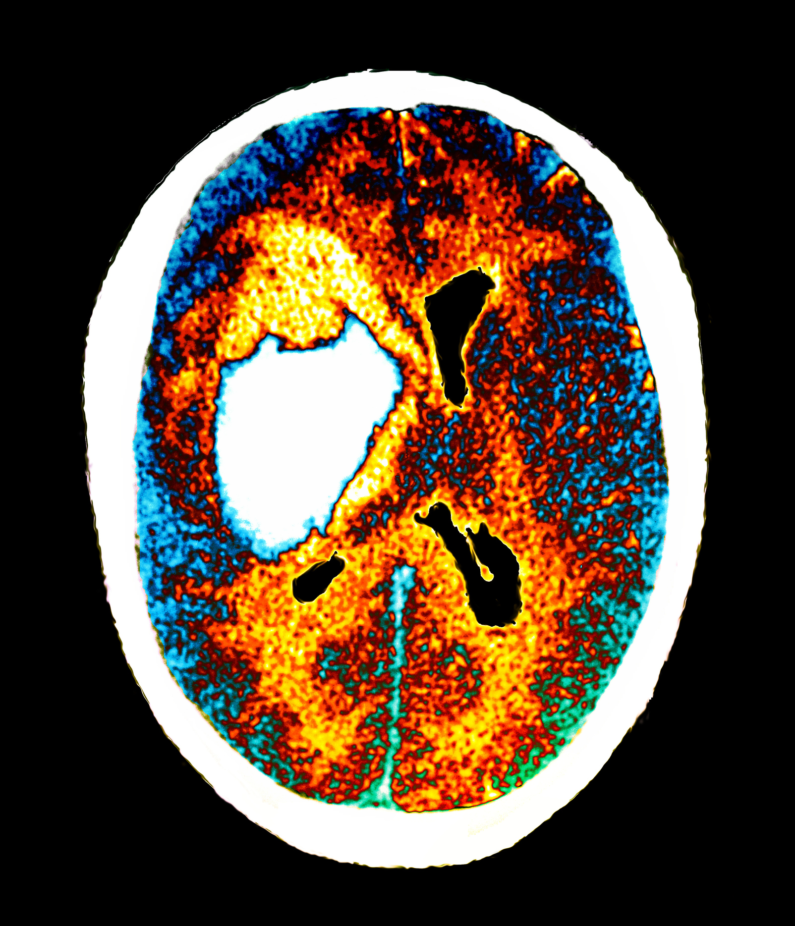 Do Most Stroke Victims Recover