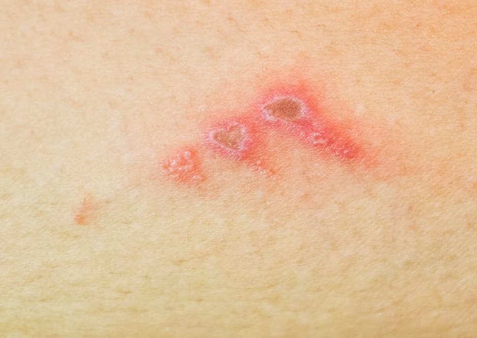 What are school sores and how do you get rid of them? - Cosmos Magazine