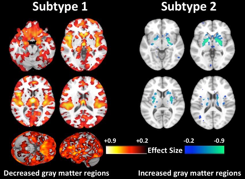 60% of patients with schizophrenia (subtype 1) had decreased grey matter volumes