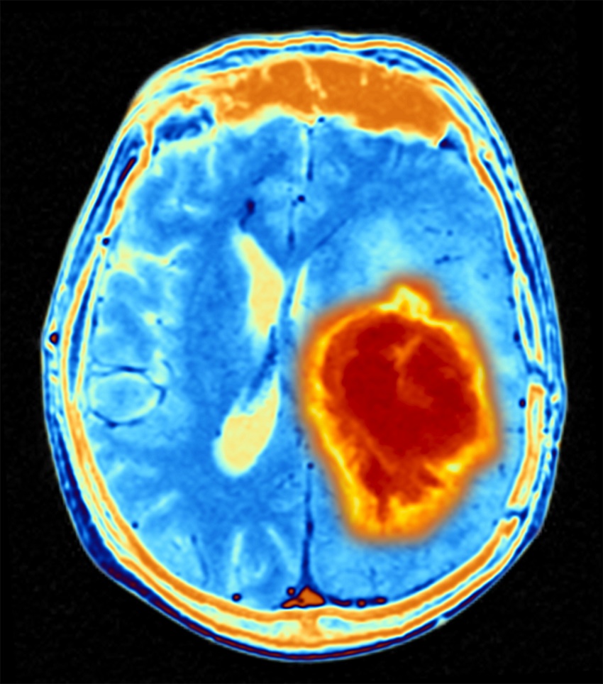 201007 brain tumour