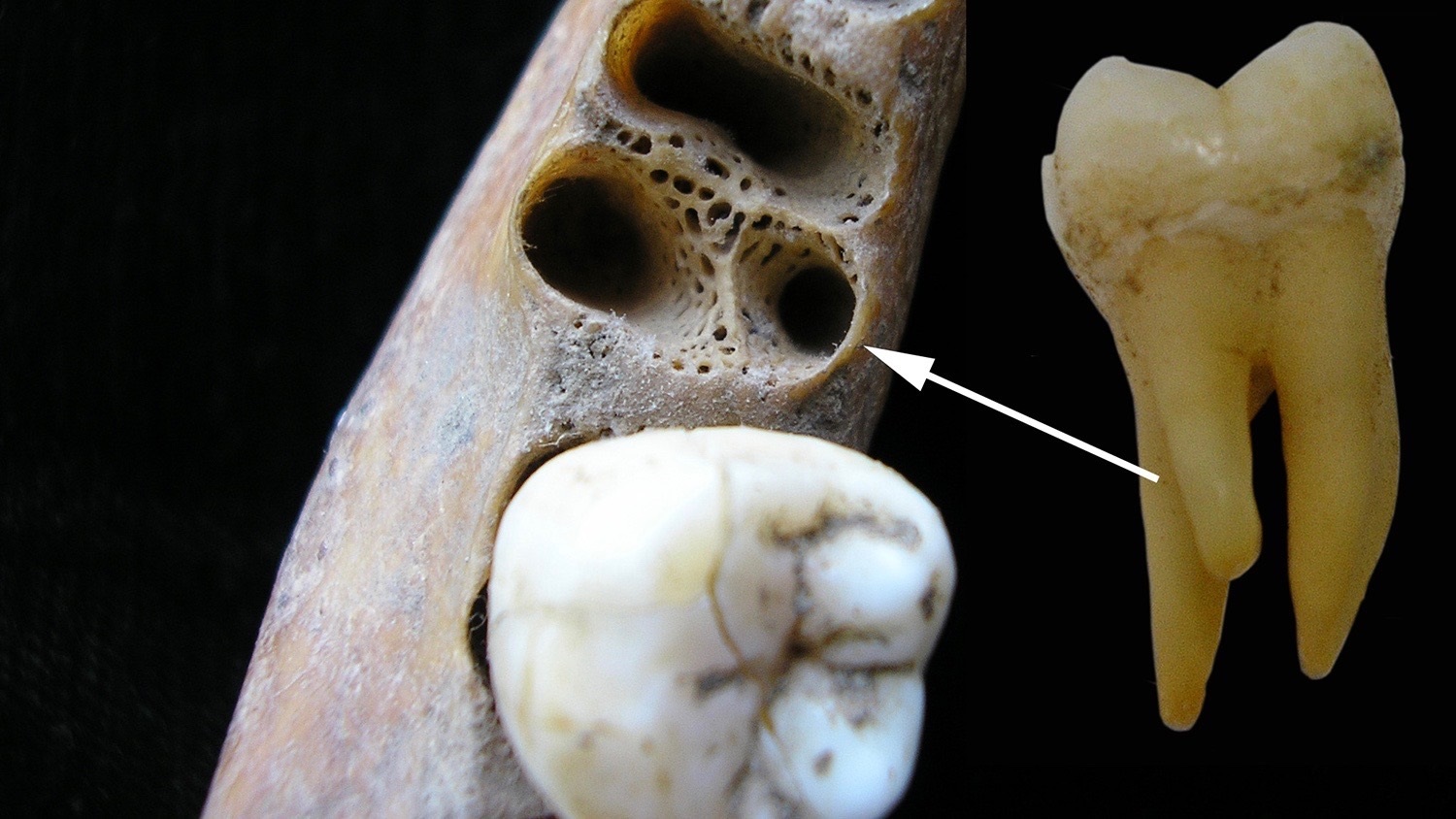 Three-rooted molars: A rare dental trait lives on