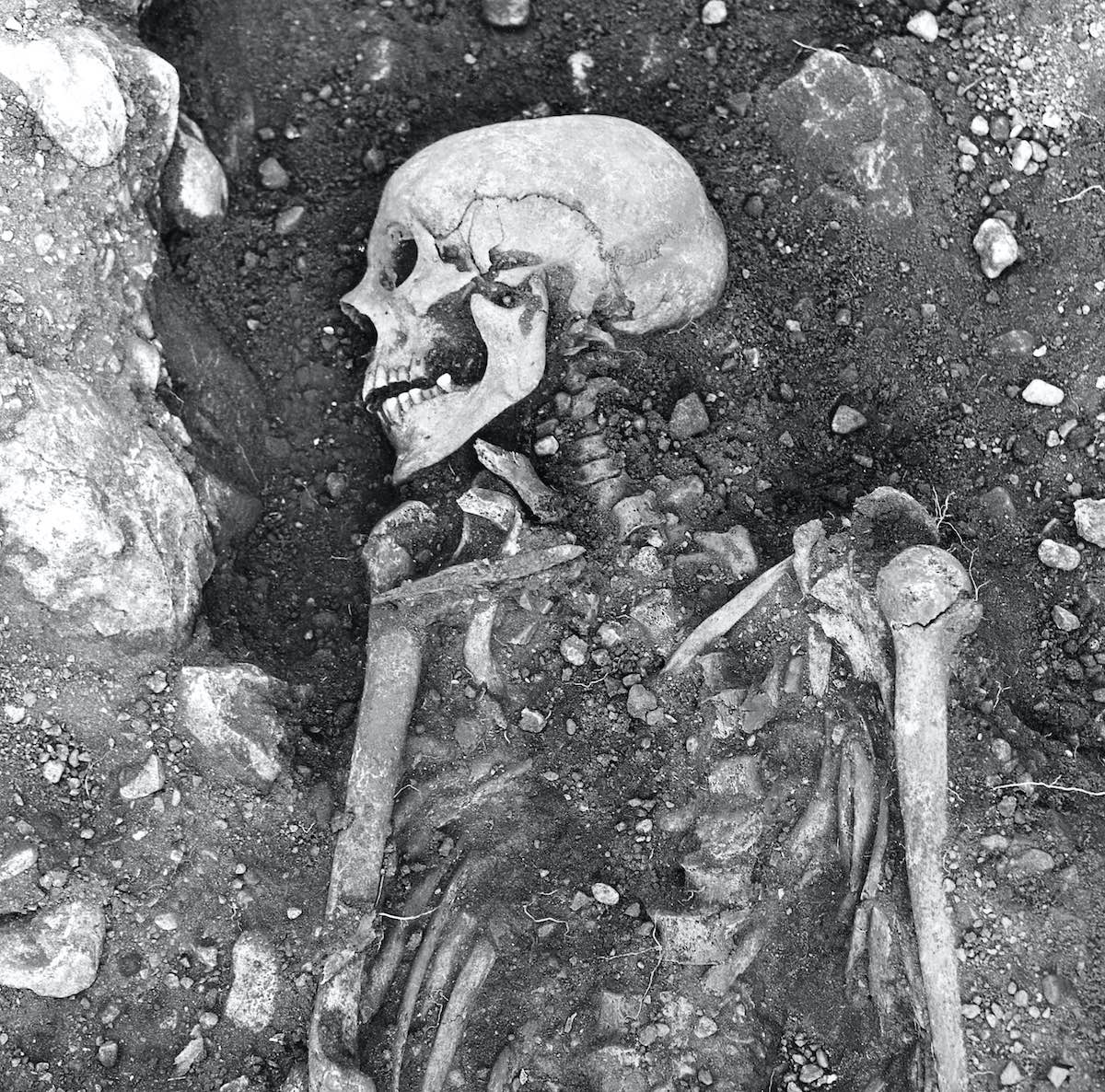 Viking skeleton_smallpox