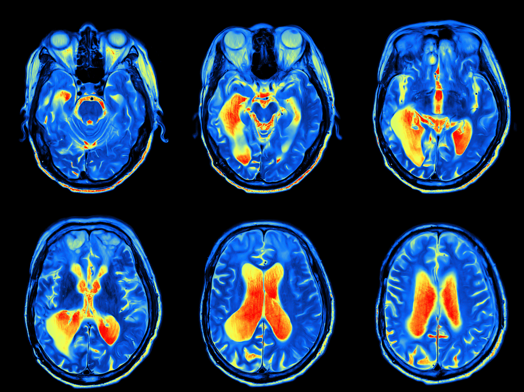 Brain scan mri neuroscience