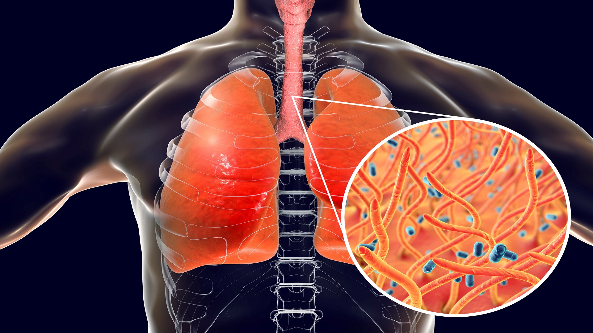 What Type Of Organism Causes Whooping Cough