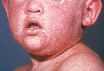 191003 measles rash infection