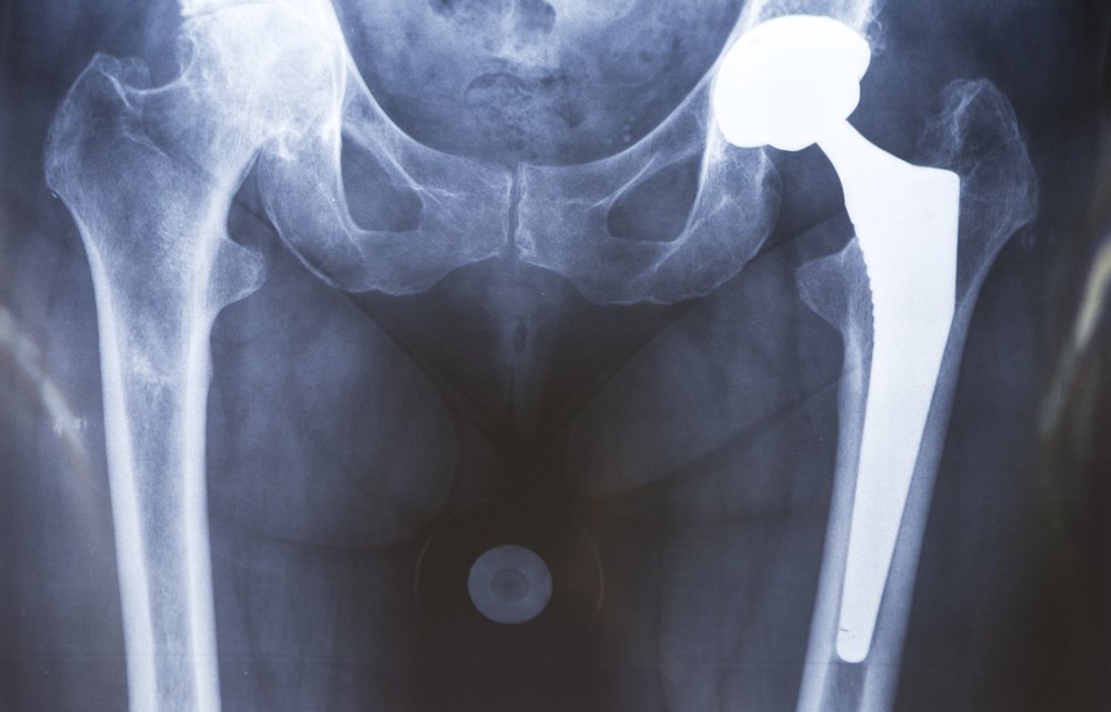 Hip & knee replacements may be bad for the heart