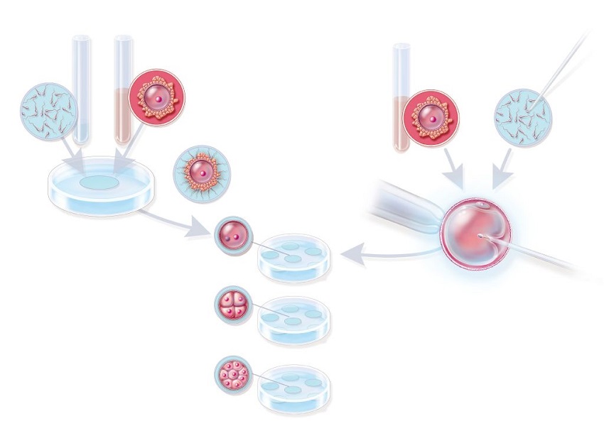 Diagram comparing ivf and icsi. With ivf, thousands of sperm compete to fertilise an egg. But with icsi, a single sperm is injected into the egg.