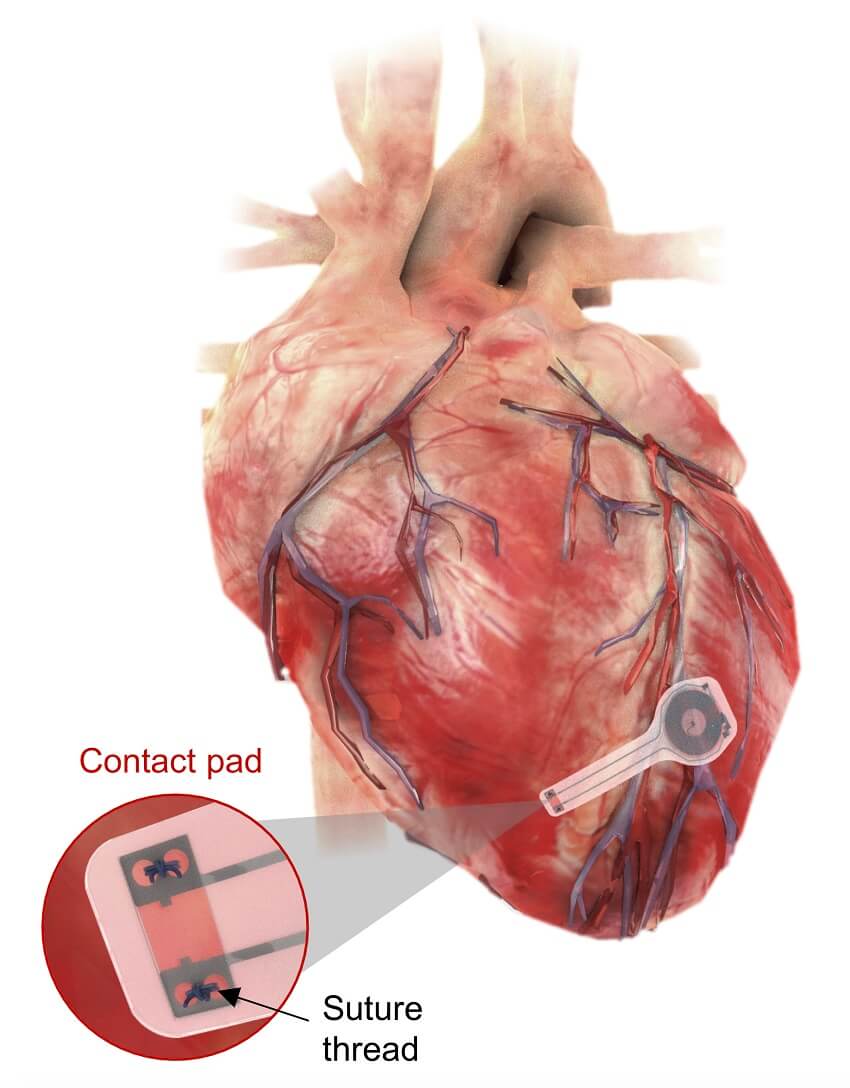 An illustration of the transient pacemaker mounted on myocardial tissue