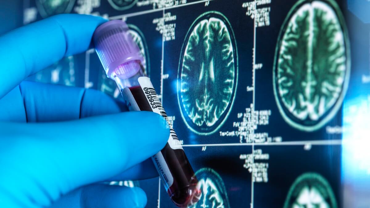 A blood test sample held in front of brain scans