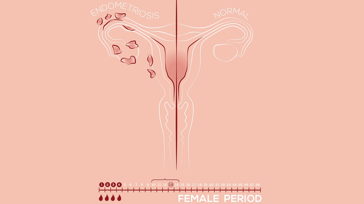 Illustration of endometriosis, endometrial tissue in the uterus. Credit: ok sotnykova / gety images. The endomtreiosis side has welts on the ovary and fallopian tube