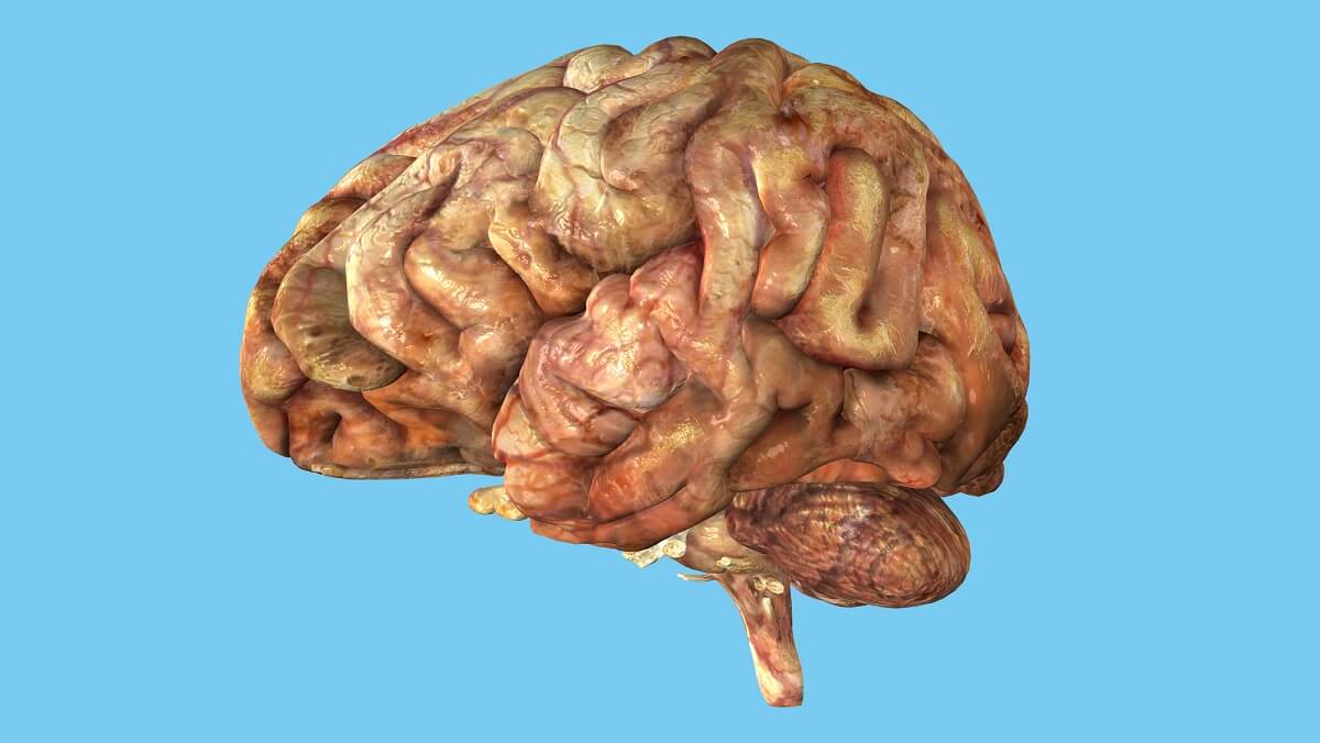 Unhealthy Brain: View from side featuring frontal lobe, parietal lobe, occipital lobe, temporal lobe, cerebellum and brain stem.