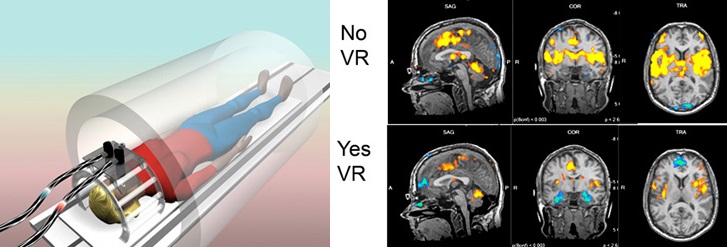 A graphic with a person in an mri machine on the left, and brain scans on the right showing that pain-realted brain activity decreases with vr.