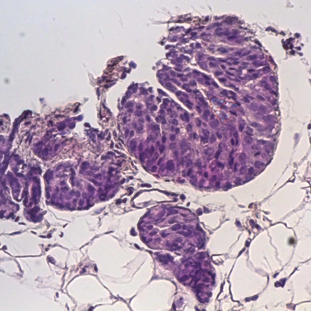 Cancerous tissue viewed on a traditional microscope slide using standard stain 1