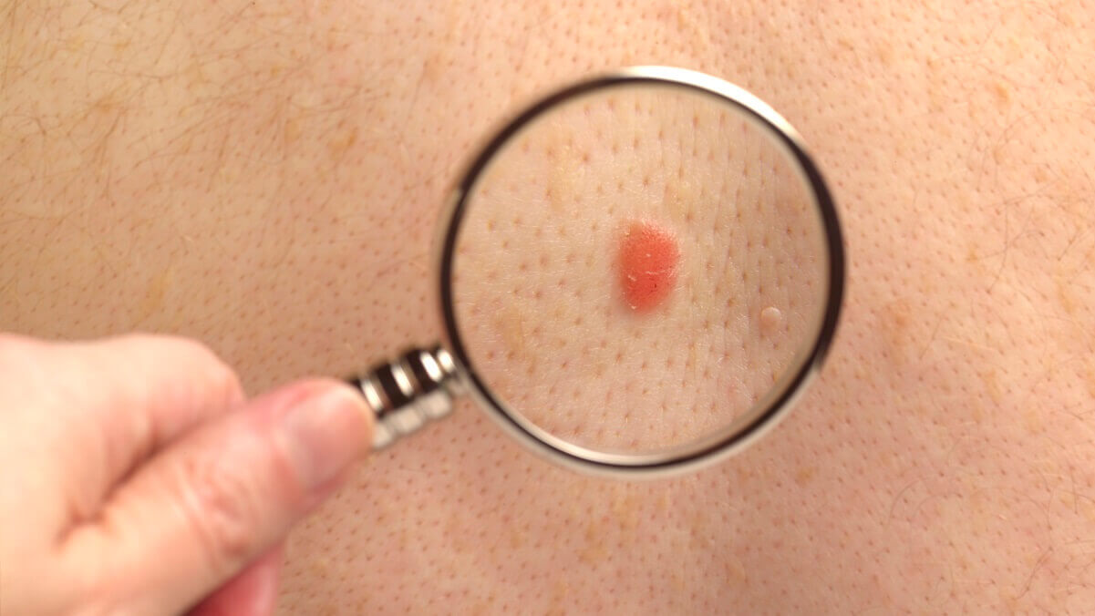 a magnifying glass over a red spot on a persons skin. It is a melanoma