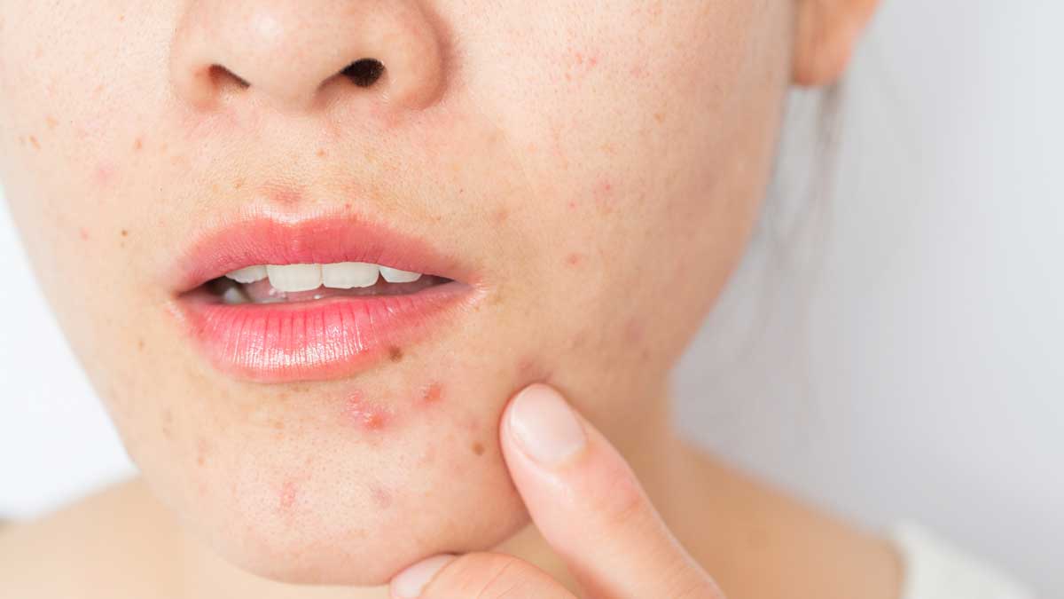 What causes acne?