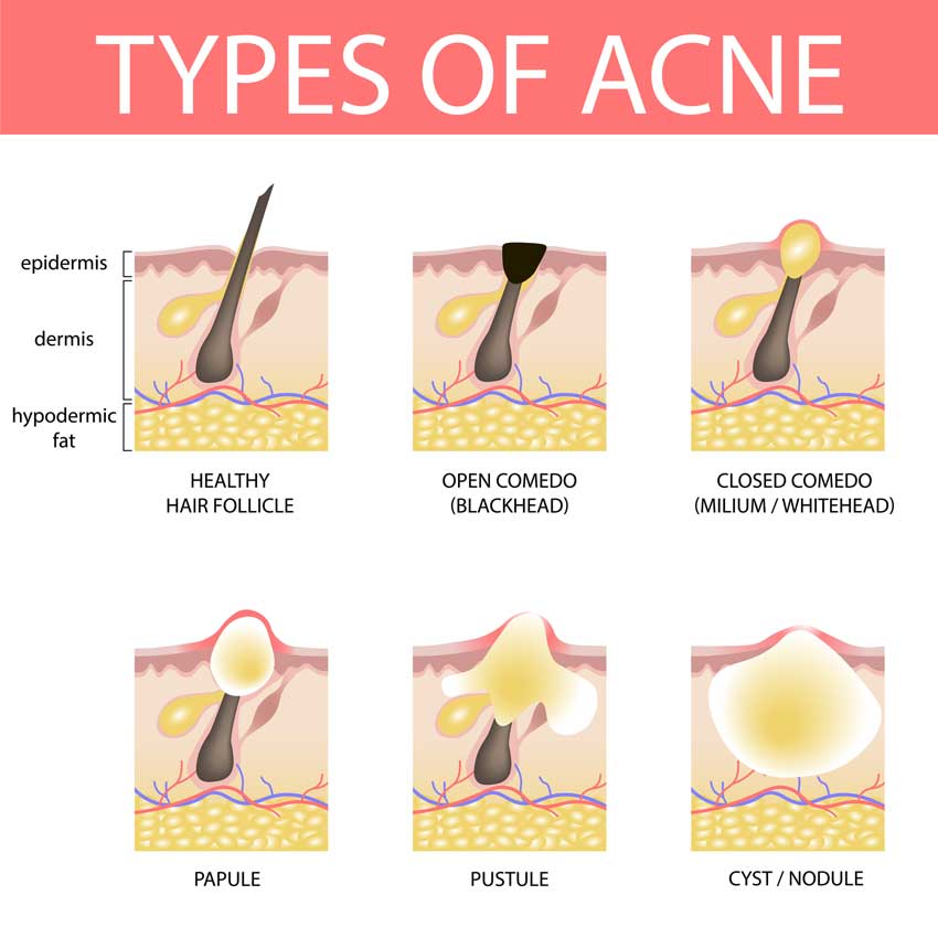 Infographic showing how different types of acne form in the skin
