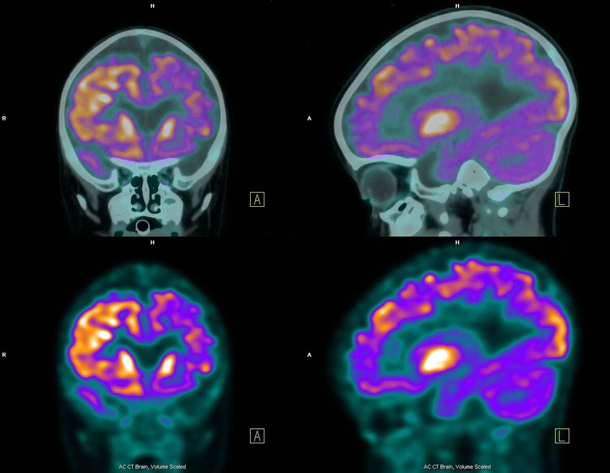 Four pet scan images of the brain, with different brain regions in different colours