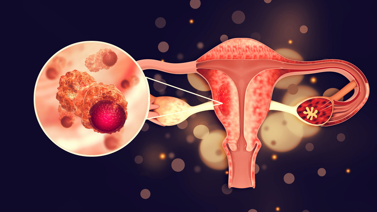 endometriosis may be linked to ovarian cancer