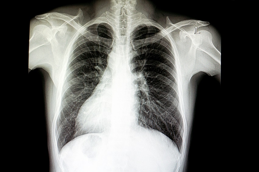 Is there asymmetry in nature? An x-ray of an individual with situs inversus shows the heart on the right side of the chest instead of the left.