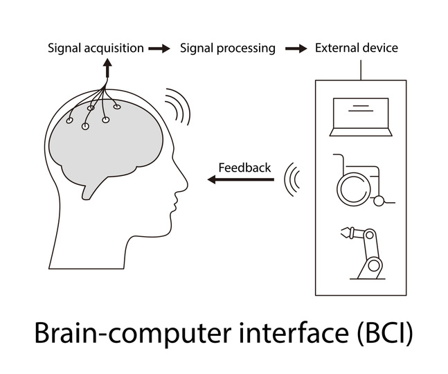 Schematic of a brain computer interface that can be used for example in motor neuron disease patients. On the left, signal acquistion showing electrodes picking up signals from the brain. Then an arrow to signal processing and a second arrow from signal processing to external device with the examples of a computer wheelchair or prosthetic arm. Then an arrow showing feedback returning from the external device to the person.
