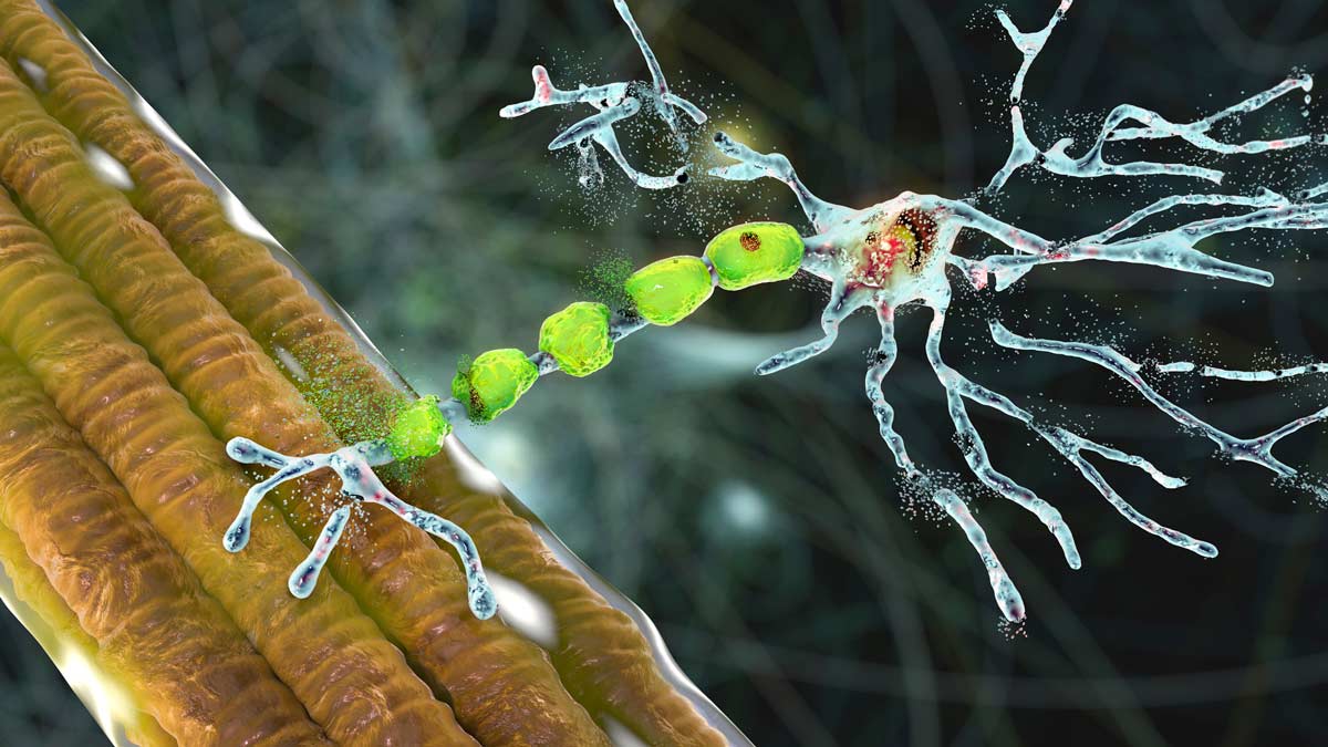 motor neuron disease concept illustration of a damaged motor neuron