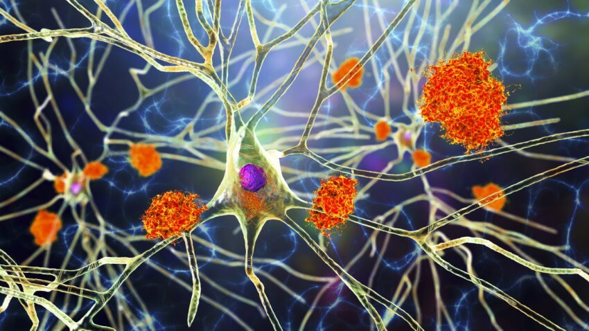 Illustration showing neurons with neurofibrillary tangles and amyloid plaques in the brain of a patient with alzheimer's disease