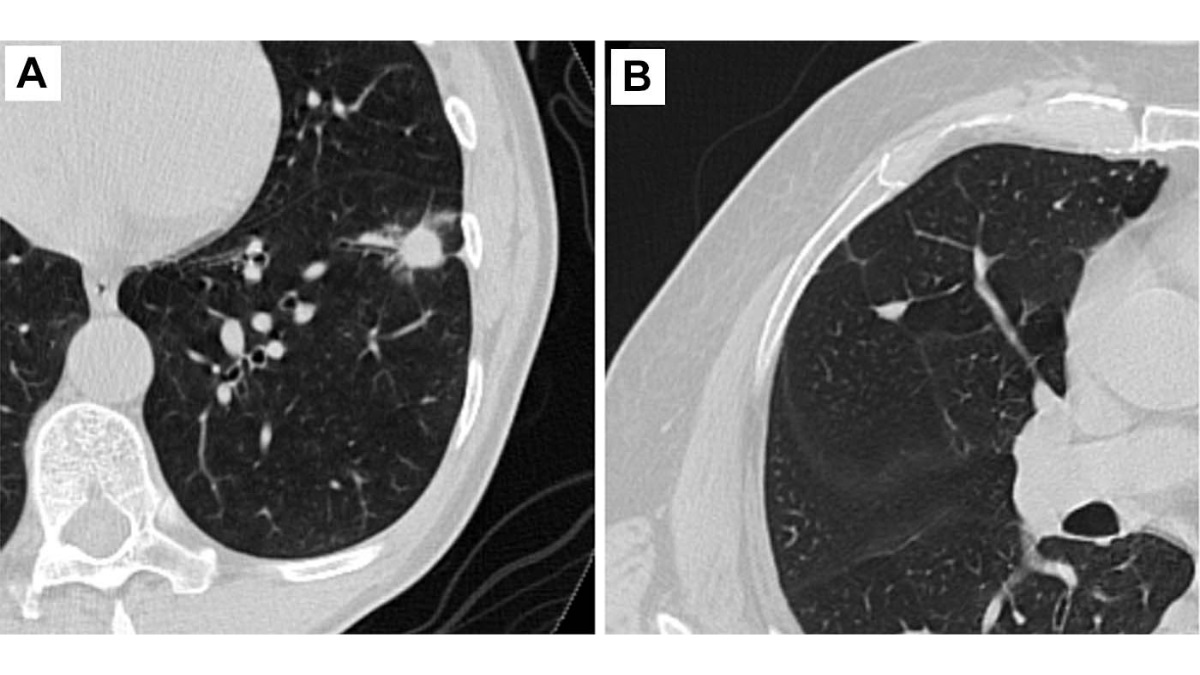 CT-chest-scans-showing-benign-and-malignant-lung-nodules