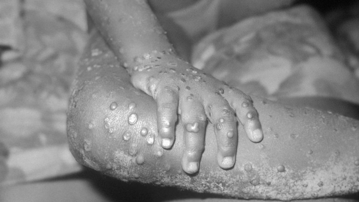 monkeypox-lesions-on-child-leg-liberia