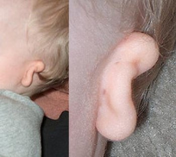 Wide shot and close up of ear with microtia, ear is very small and no holes are visible