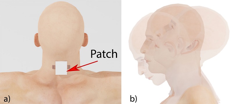 Drawing of back of person's head with patch attached, second panel shows head from the side looking backwards and forwards