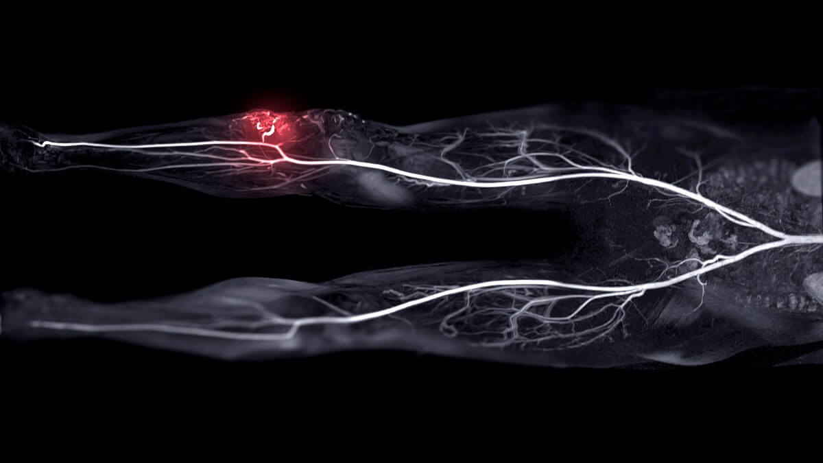 Magnetic resonance angiography showing arteriovenous malformation, which has been shown to be treated with thalidomide.
