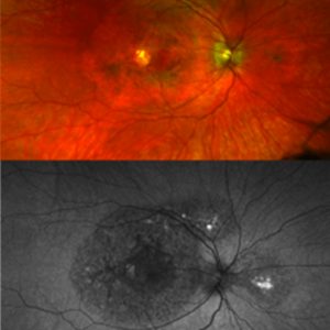 Images of the retina of a patient with a timp3 mutation