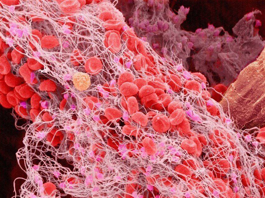 A scanning electron micrograph of a human blood clot.