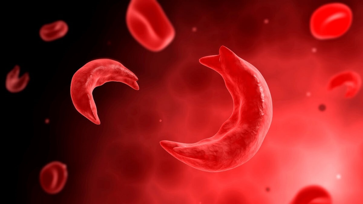Illustration of sickled red blood cells which occur in sickle cell disease