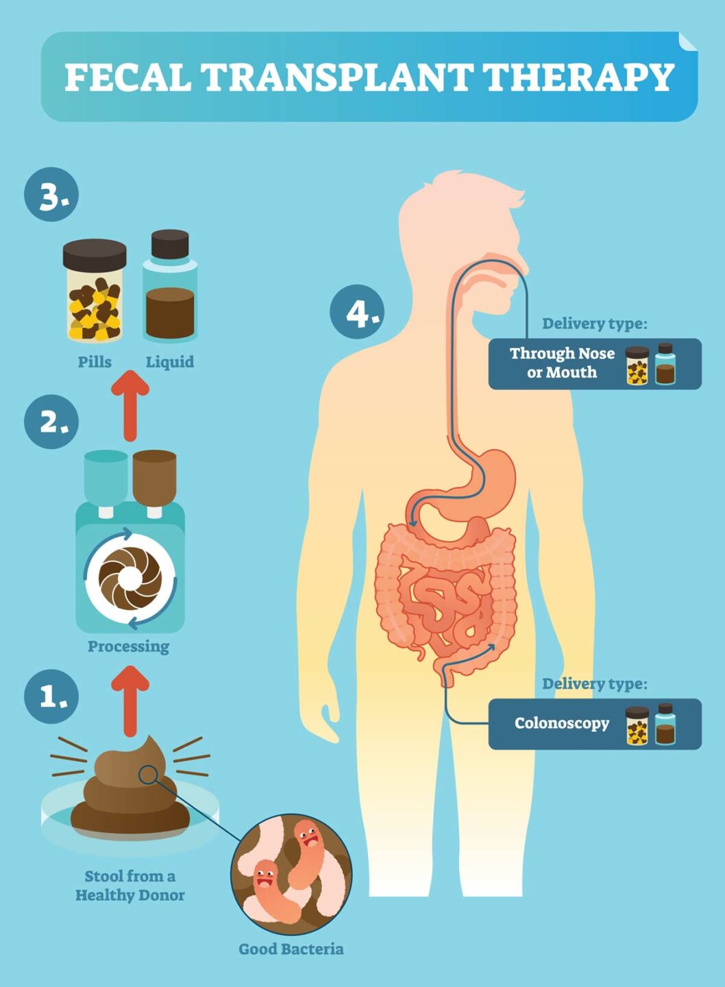 Autologous fmt concept a schematic explaining the concept of faecal microbiota transplant a poo sample is taken made into pills or an enema and delivered to the recipient's gut