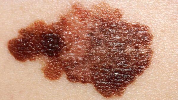 Melanoma on a patient's skin.